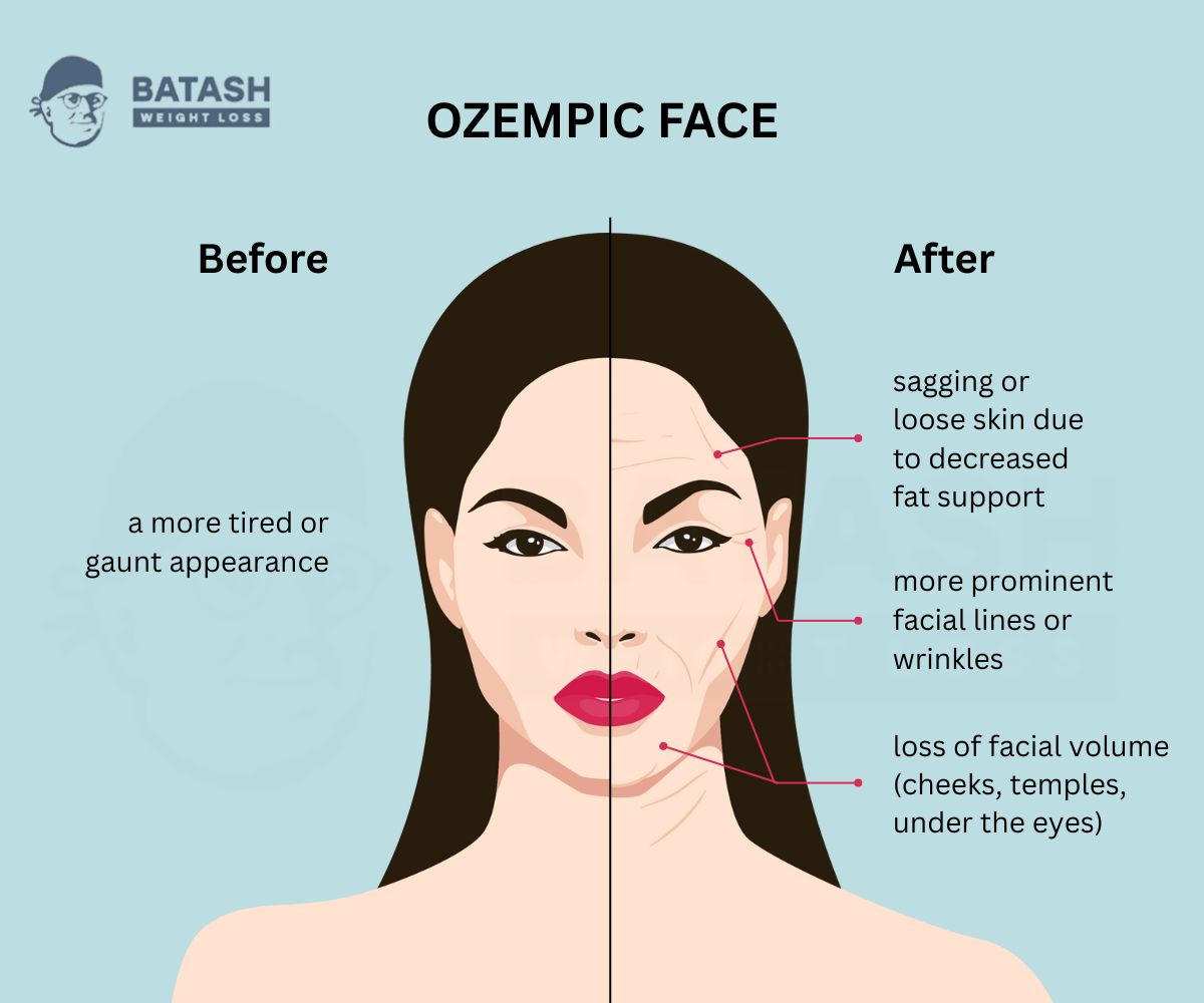 Is Ozempic Face Real? Causes, Prevention & How to Restore